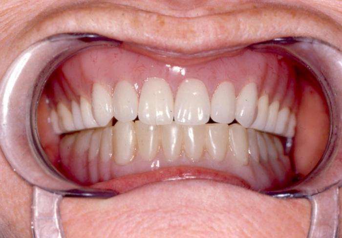 съемные зубные протезы отзывы