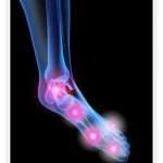Артрит суставов стопы: причины, признаки и лечение