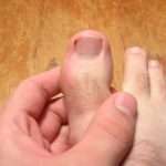 Вросший ноготь на большом пальце ноги: фото, причины, методы лечения