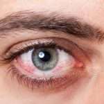 Симптомы и лечение синдрома сухих глаз: лучшие средства лечения, отзывы