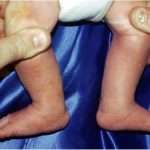 Дисплазия тазобедренных суставов у ребенка - весомый повод для беспокойства