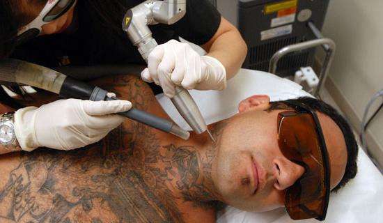 удаление татуировок лазером цена