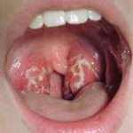 Откуда берется стафилококк в горле. Симптомы заражения