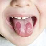 Пятна на языке у ребенка: причины и лечение