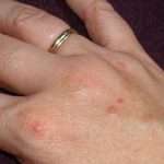 Водянистые пузырьки на пальцах рук: симптоматика и лечение