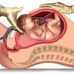 Кесарево сечение: восстановление после него и прогноз последующих родов