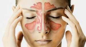 Воспаление придаточных пазух носа, или Что такое синуситы