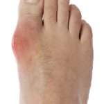 Шишки на пальцах ног: причины и лечение