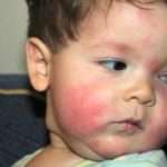 Пищевая аллергия у ребенка: что делать?
