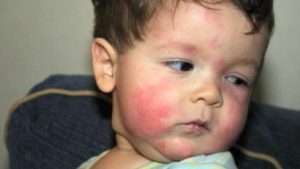 Пищевая аллергия у ребенка: что делать?