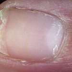 Опасны ли болезни ногтей на руках?