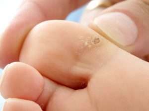 Шипица на ноге: лечение препаратами и народными средствами