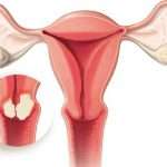 Лечение рака шейки матки: стадии, методы лечения, прогноз