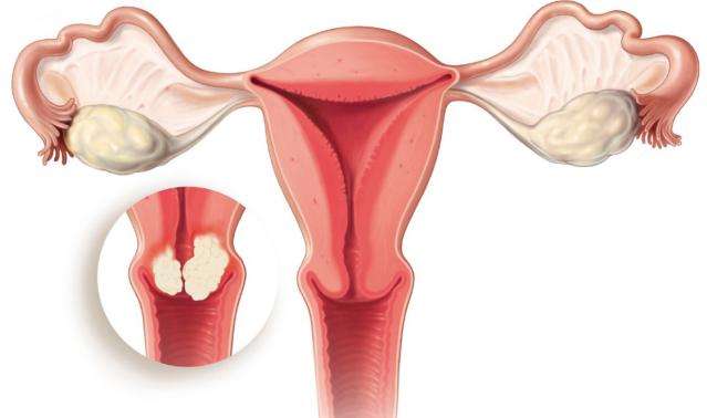 Лечение рака шейки матки 2 стадии