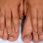 Средства от грибка ногтей на ногах: лечение и профилактика