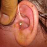 Отит уха: лечение, симптоматика и причины возникновения