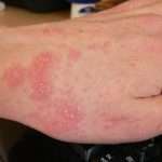 Причины аллергии на солнце и методики ее лечения