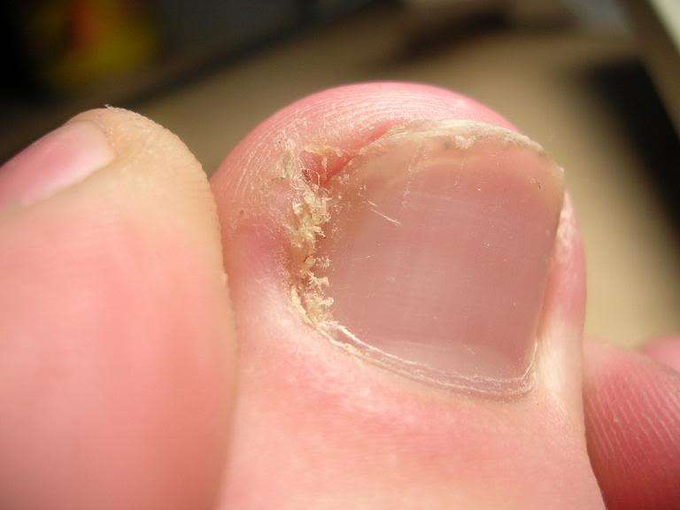 Вросший ноготь на большом пальце ноги лечение