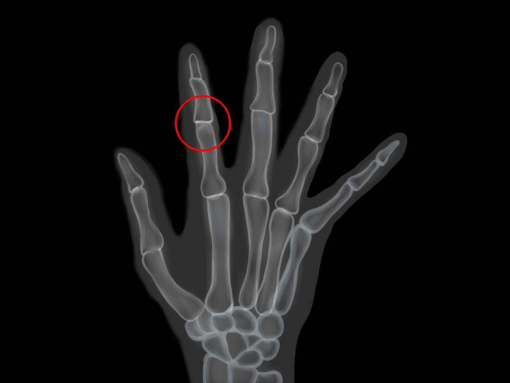 Рентген пальцев