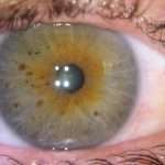 Черные точки в глазах: что это такое, причины возникновения и особенности лечения