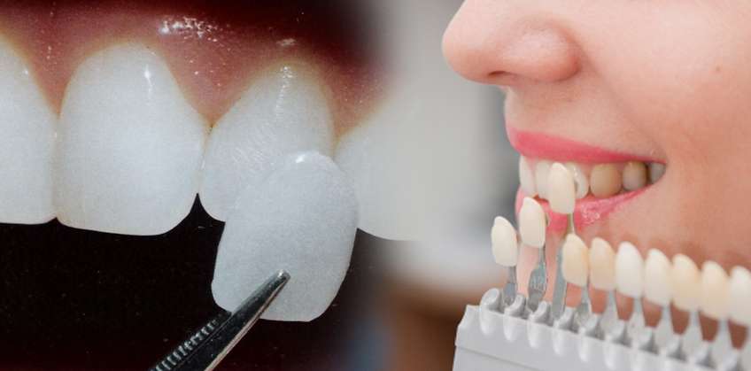 Восстановление зубов винирами