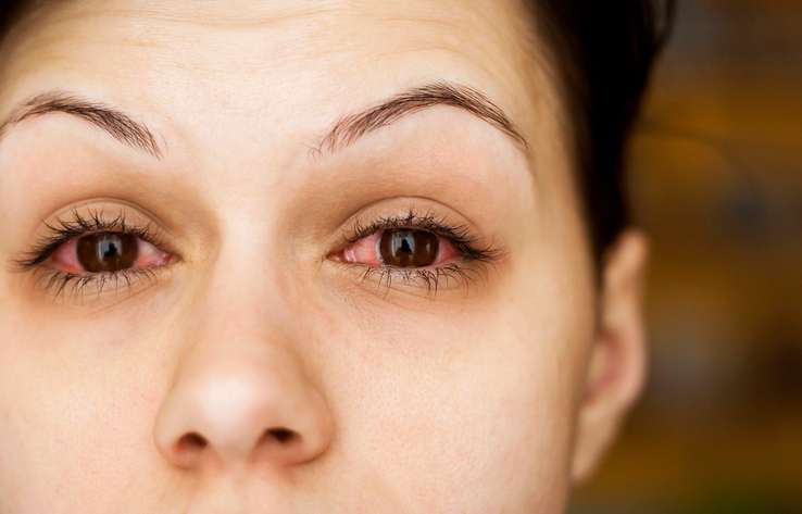 покраснение глаз и-за аллергии