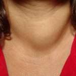 Проблемы с щитовидкой. Симптомы заболевания и методы лечения