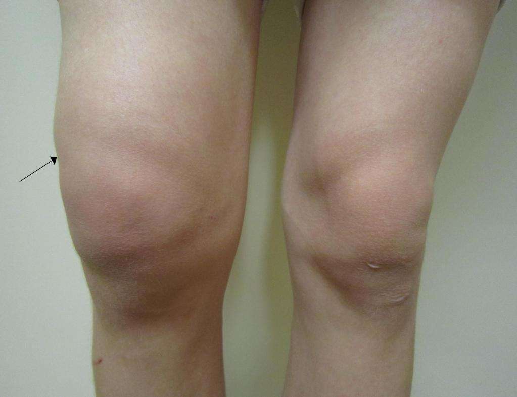 Симптомы и лечение коленного мениска