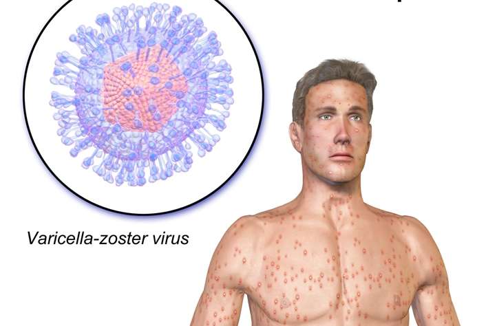 варицелла-зостер вирус
