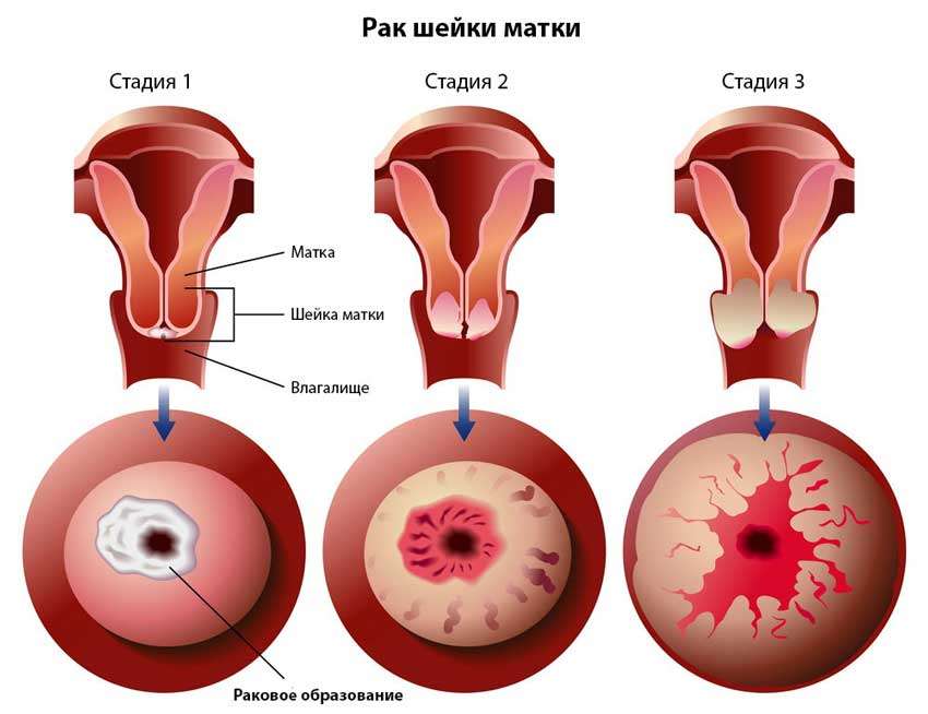 рак шейки матки: стадии