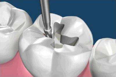 пломбировочные материалы в стоматологии