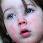 Псевдотуберкулез у детей: симптомы и лечение