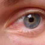 Кератит глаза: симптомы и лечение