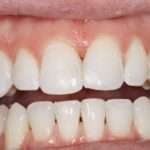 Зубные протезы на присосках: описание, фото