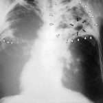 Опасен ли инкубационный период туберкулеза?