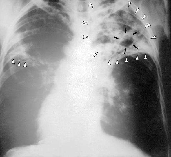 инкубационный период туберкулеза