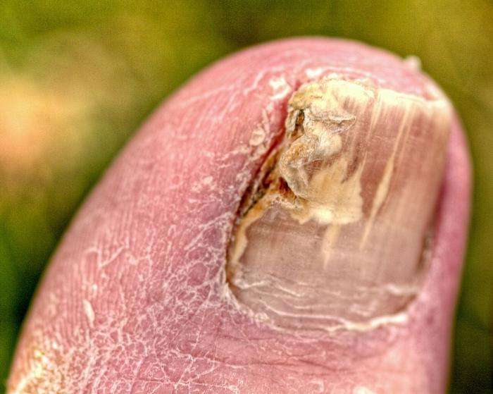 Средство для лечения грибка ногтей