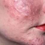 Клещ под кожей: признаки его появления и методы лечения