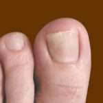 Эффективное лечение грибка ногтей на ногах народными средствами