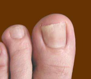 Лечение грибка ногтей на ногах народными средствами