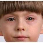Красные глаза у ребенка: причины, лечение и профилактика