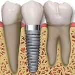 Что рекомендуют стоматологи, когда возникает необходимость вставлять зубы?