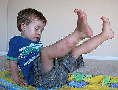 ребенка покусали комары