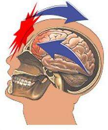 диагностика сотрясения мозга