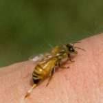 Что делать при укусе пчелы? Первая помощь