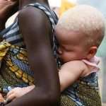 Почему танзанийский негр-альбинос не доживает до зрелого возраста?
