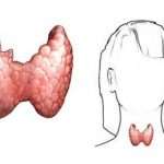 Гипертиреоз щитовидной железы: причины, симптомы, диагностика, лечение