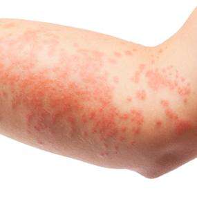 инфекционные заболевания кожи