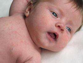 Вирусный менингит симптомы у детей