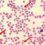 Патологический гемолиз крови: причины, симптомы и методы лечения